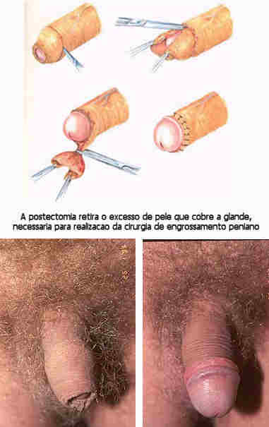 Postectomia - Cirurgia de Fimose para realizacao de aumento peniano