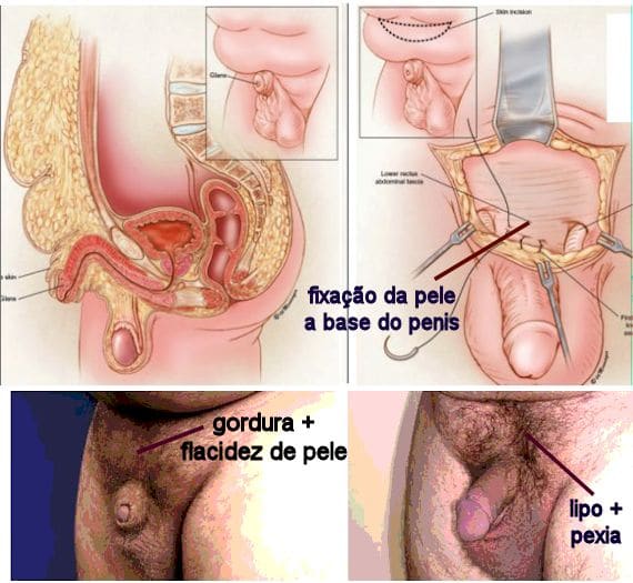 chirurgia penisului masculin